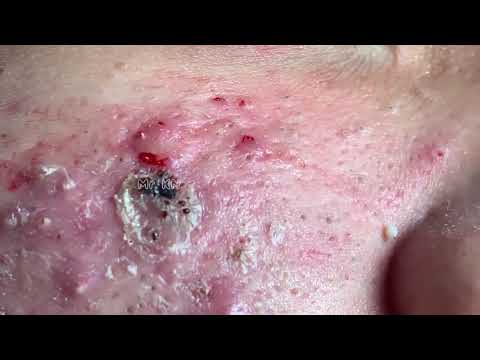 Alia's Beauty 110 Blackheads & Milia, Big Cystic Acne Blackheads Extraction Whiteheads Removal