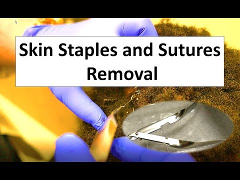 How To Remove Skin Staples and Sutures