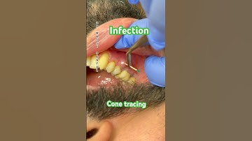 Dental Fistula, Tracing Gutta Percha