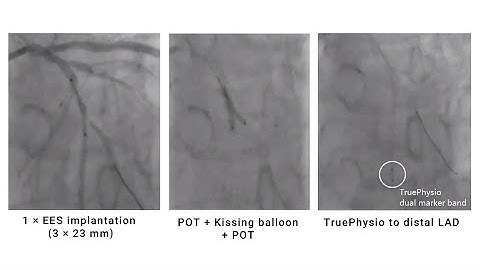Post-PCI FFR and pullback assessment for bifurcation lesion in multi-vessel disease