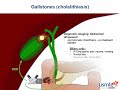 Express Video of the Week: Gallstones (cholelithiasis)