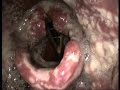 Disseminated gonorrhea scattered fibrinous lesions in the pharynx and larynx