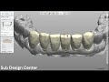 3shape design anterior teeth temp shell       