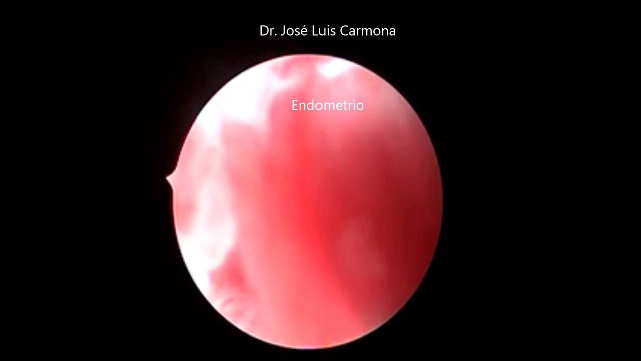 Histeroscopia Hiperplasia endometrial compleja con atipia. Dr. José