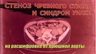 ТАХИКАРДИЯ после еды при синдроме Уилки, СТЕНОЗЕ чревного ствола на РАСШИФРОВКЕ КТ брюшной аорты