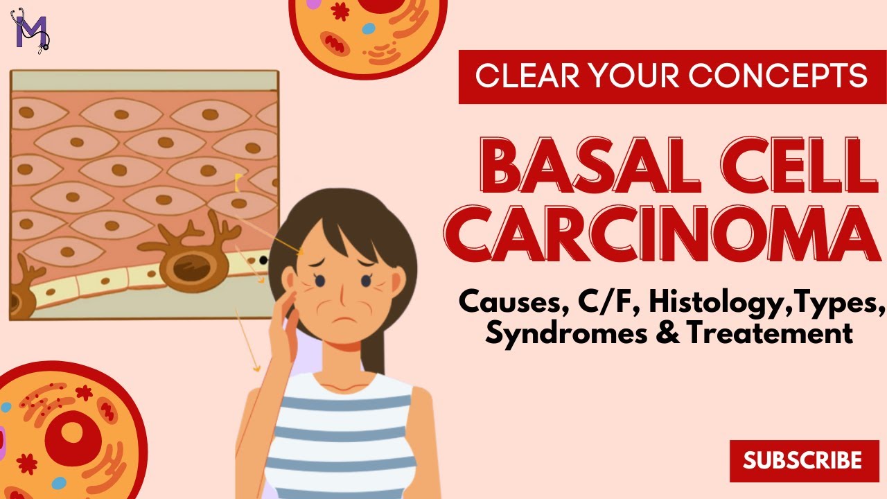 Basal Cell Carcinoma YouTube