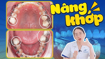 Nâng Khớp Cắn Trong Niềng Răng - Vì Sao 70% Khách Hàng "Bắt Buộc" Phải Nâng Khớp? Tiết Lộ Cực Sốc!