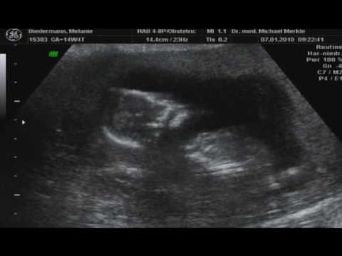 Ultraschall 15 Ssw Teil 2 Youtube