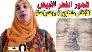 أول ظهور للفطر الأبيض أخطر وأشرس بكثير من الفطر الأسود