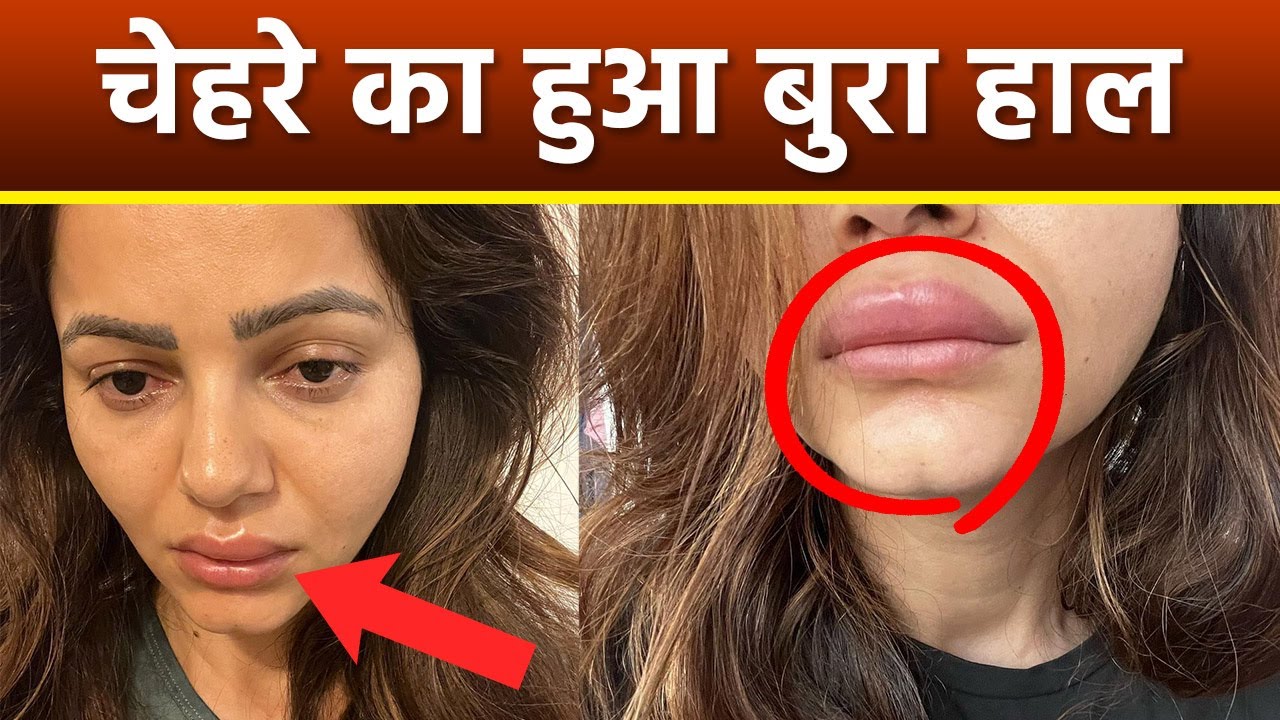 Rubina Dilaik Face Swelling के बाद हुआ बुरा हाल, Eyes, Lips पर दिखे
