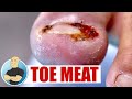 HUGE TOE MEAT INGROWN NAIL REMOVAL ***THICK &amp; JUICY 🔪🥩🤤***