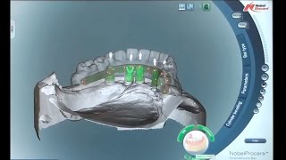 Bar-retained implant-supported overdentures are a proven prosthetic solution. NobelProcera™ 3-D prosthetic design software 