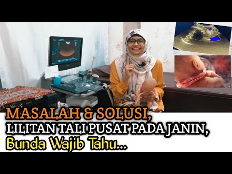 #61. Masalah & Solusi, Lilitan Tali Pusat pada janin, Bunda Wajib tahu...