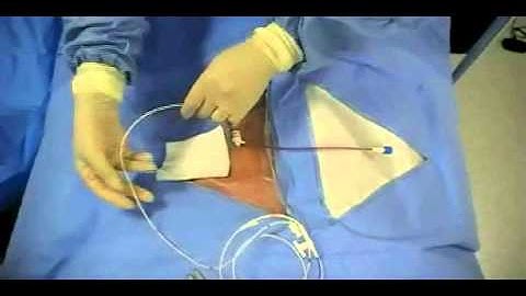 Insertion of Transvenous Pacemaker