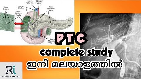 PTC-PERCUTANEOUS TRANSHEPATIC CHOLANGIOGRAPHY- complete study explained in Malayalam.