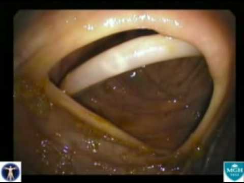 Caso clinico. Ascariasis. Ascaris lumbricoides.