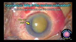 CataractCoach™ 2145: CataractQuiz: Why is the nucleus subluxated?