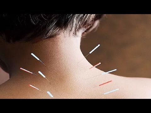 Accupuncture For Neck Pain – Acupuncture For Neck Pain