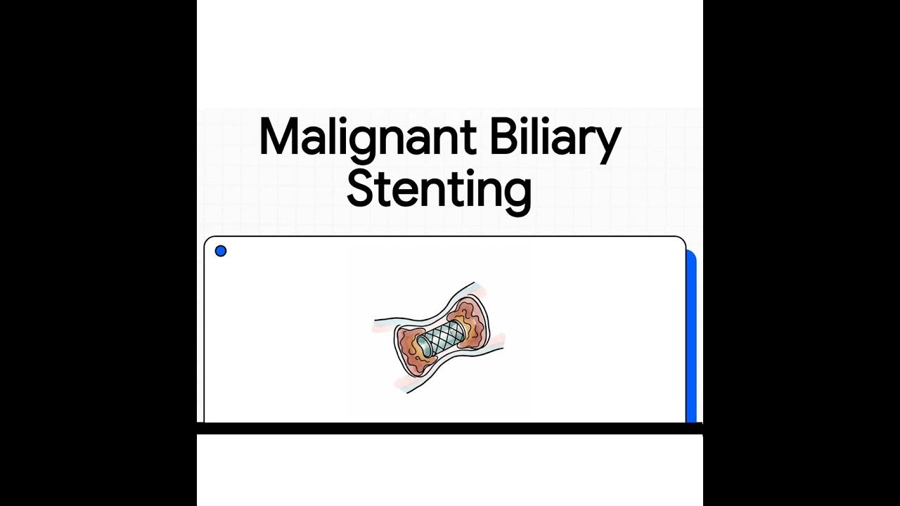 Malignant Biliary Stenting | Clinical Principles, Techniques & Decision-Making