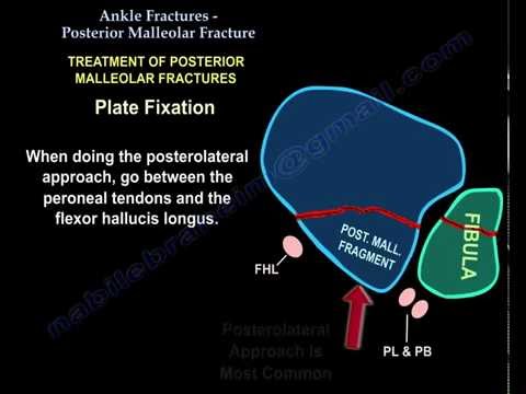 Ankle Fractures,and  Posterior Malleolar Fracture - Everything You Need To Know - Dr. Nabil Ebraheim
