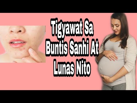 Video: Acne Habang Nagbubuntis. Mga Sanhi At Pamamaraan Ng Paggamot