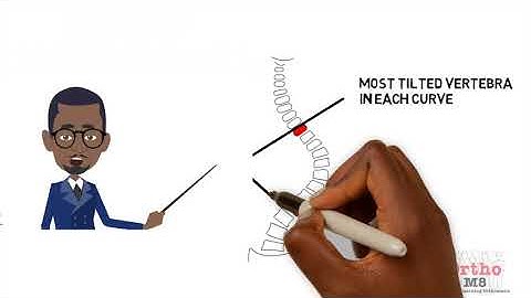 Radiographic features - Cobb angle
