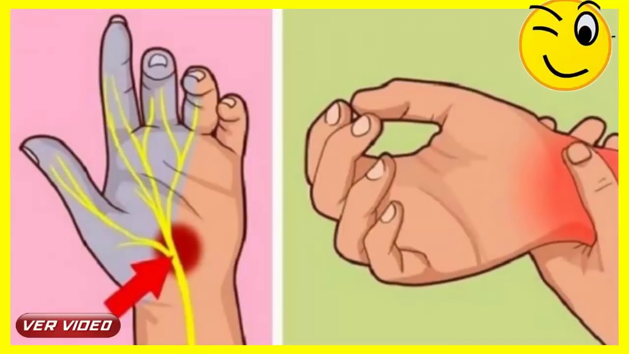 2 пальца на запястье. Туннельный карпальный синдром руки. Карпальный (кистевой) туннельный синдром. Онемение рук туннельный синдром. Карпальный туннельный синдром рентген.
