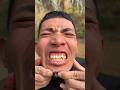 How I Cured a Bug Bite with Yogurt in theWild |Survival Hacks #funny #asmr #yeni #comedy #shorts