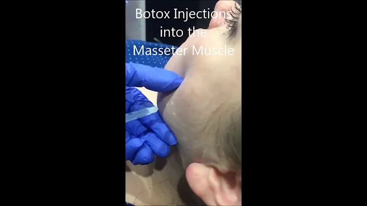 Dr. Riehm discusses Masseter Muscle Injections