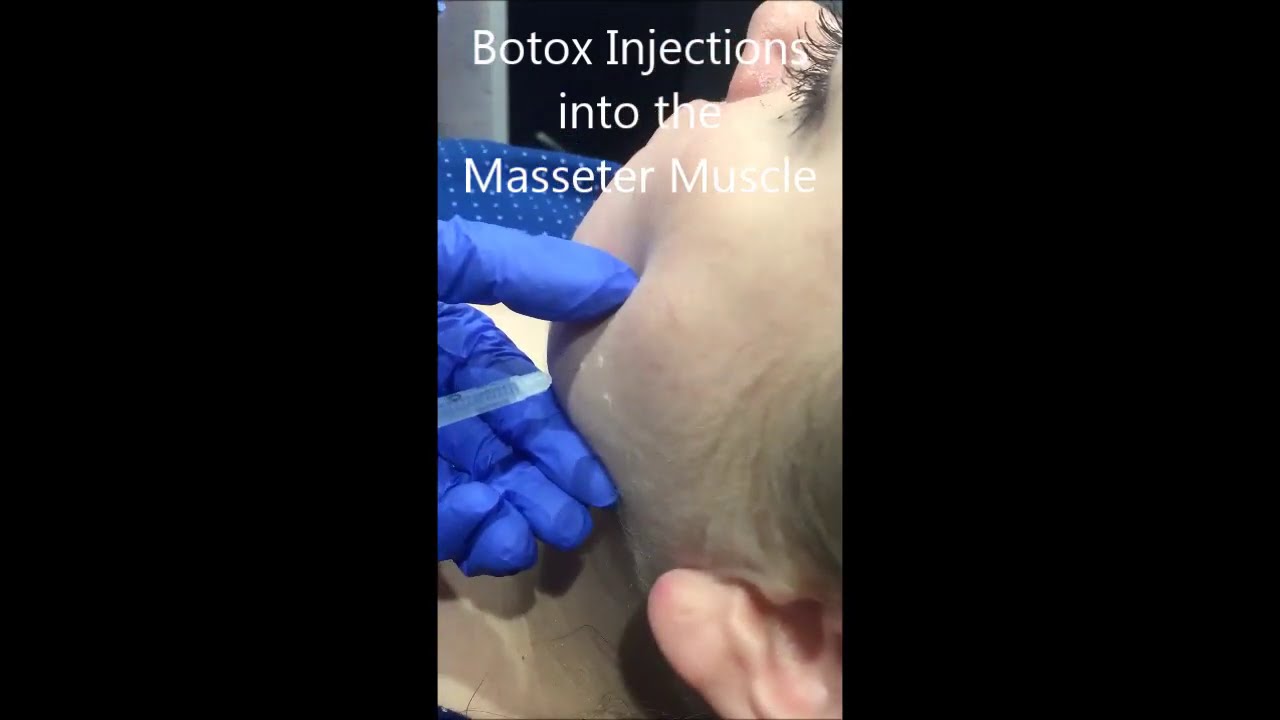 Dr. Riehm discusses Masseter Muscle Injections - YouTube