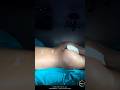 Natural Safe BBL + HD Liposuction | Defined Abs &amp; Curves Transformation @iMedMedical