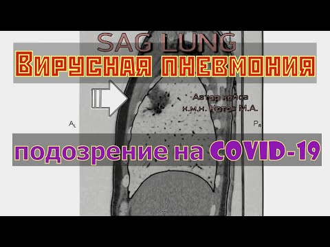 Вирусная пневмония на расшифровке КТ легких с подозрением на коронавирус COVID 19