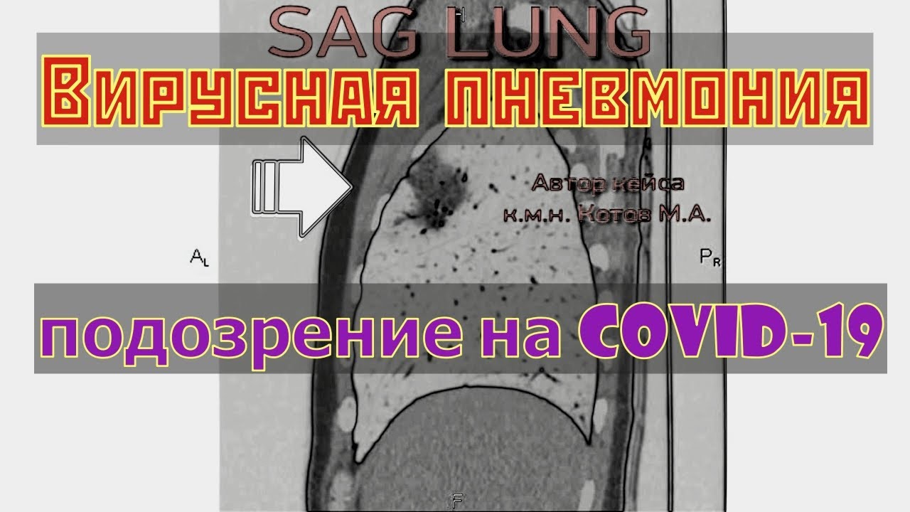 Вирусная пневмония на расшифровке КТ легких с подозрением на коронавирус COVID 19