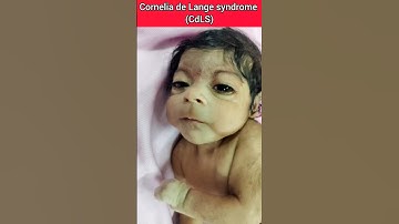 Cornelia de Lange syndrome (CdLS) #babyvideos #babyshorts #medicalshorts#youtubeshorts