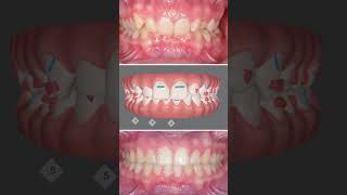 Invisalign Deep Bite Correction: Vertical Control &amp; Digital Planning