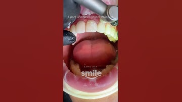 Upper Composite Veneer Makeover #shorts