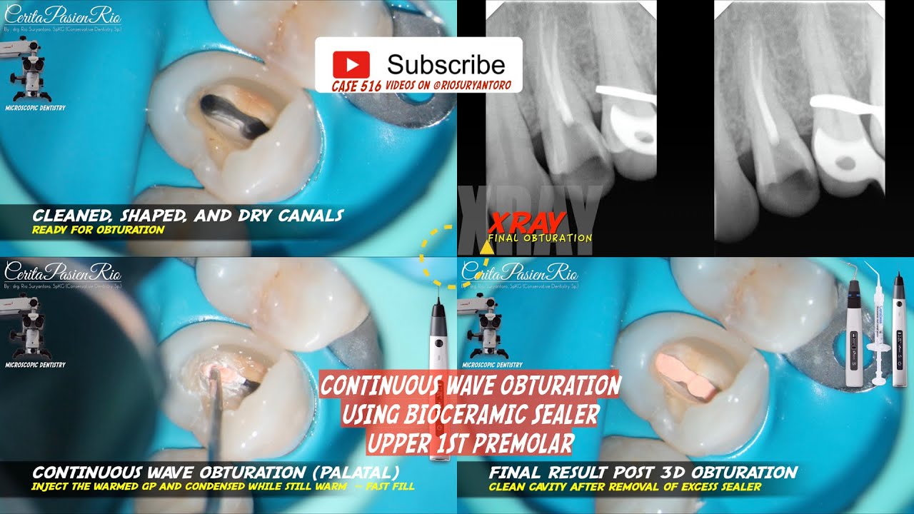 CONTINUOUS WAVE OBTURATION USING CERASEAL BIOCERAMIC SEALER MAXILLARY