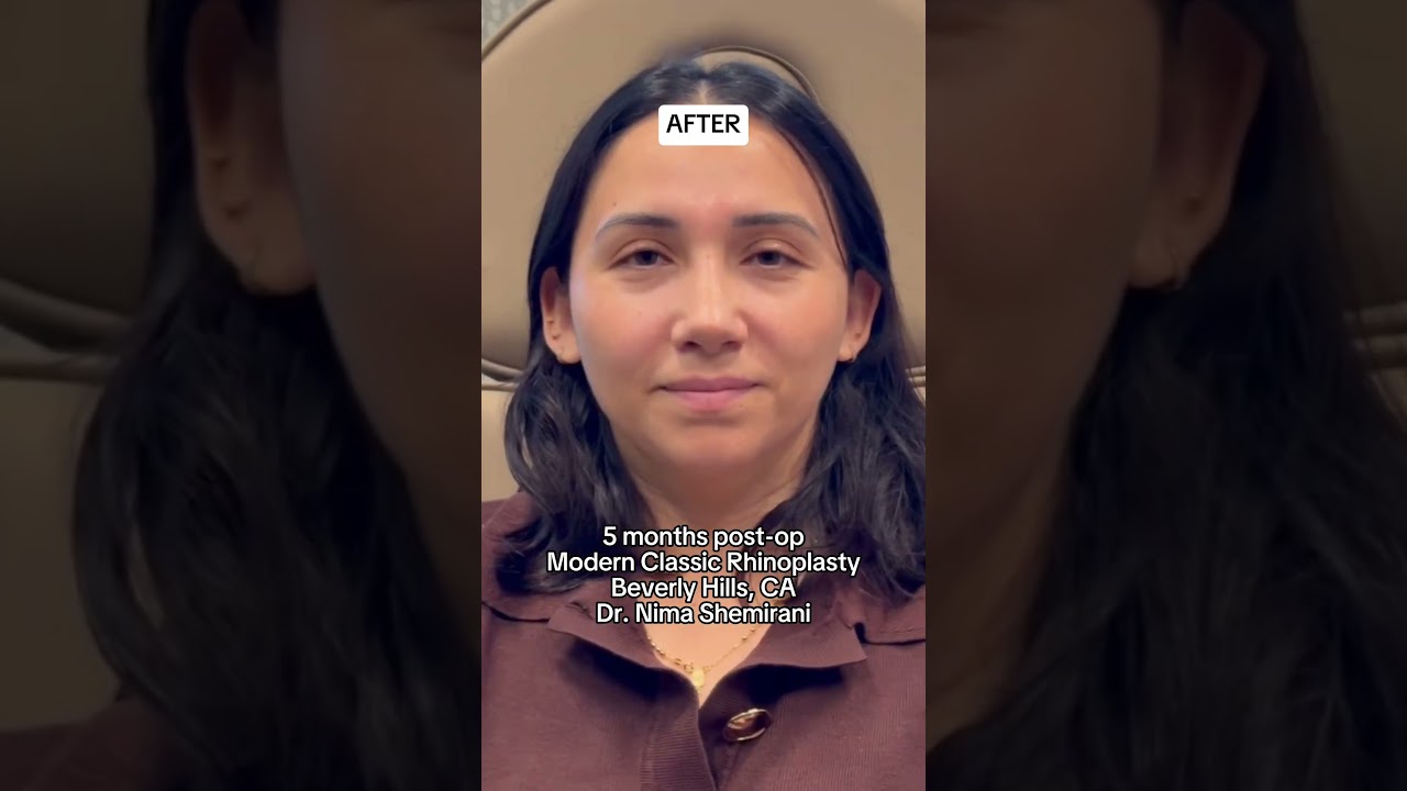 A natural and refined nose for my patient!