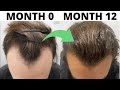 SEVERE Hair Loss To EPIC Hair Growth (Subscriber REVERSES Male Pattern Baldness In 1 Year)
