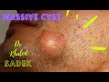 Massive Face Cyst. Dr Khaled Sadek. LipomaCyst.com