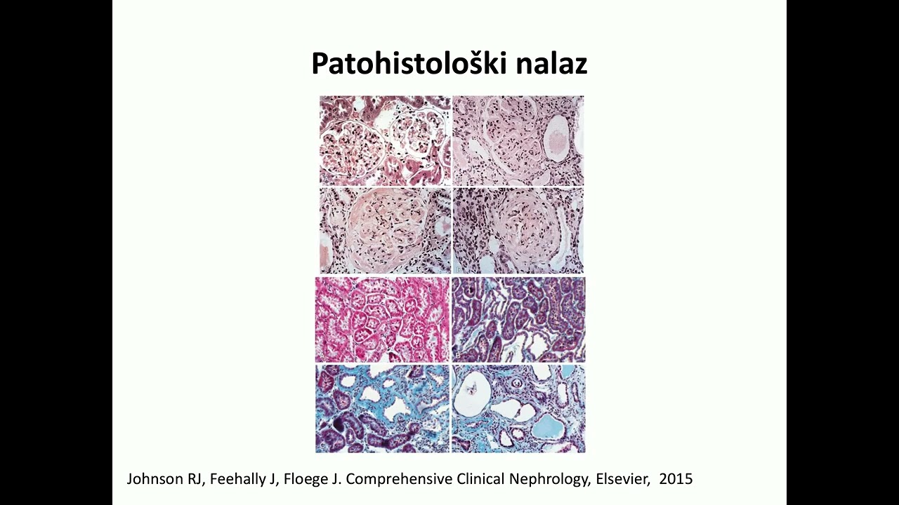 4  Hronična bolest bubrega doc dr M Laušević   Hronična bolest bubrega etiologija,