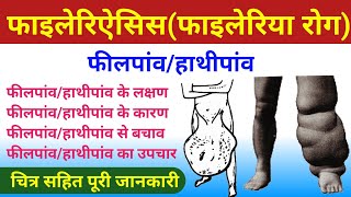 फाइलेरिऐसिस (फाइलेरिया रोग) | filaria ke lakshan | filariasis | elephantiasis | फीलपांव | हाथीपांव