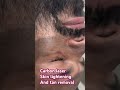 Carbon laser skin lightening call 9411462881 #skincare #budaun#skincareroutine #skin#skinwhitening