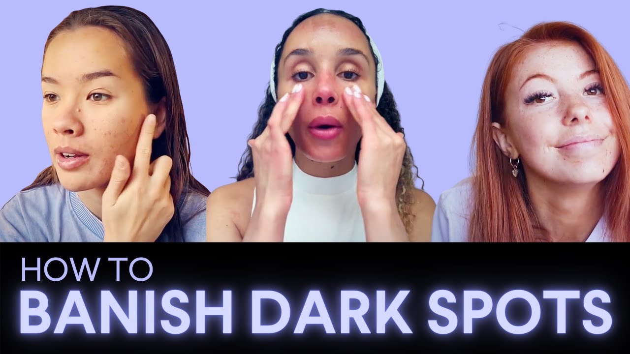 3 Types of Dark Spots & How to Treat Them | Hyperpigmentation ...