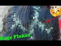 Itchy psoriasis scalp | Dandruff Scratching Big Flakes No Talking Huge Flakes