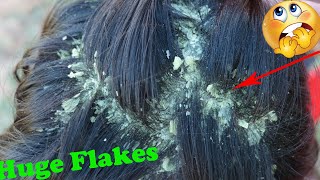 Itchy psoriasis scalp | Dandruff Scratching Big Flakes No Talking Huge Flakes