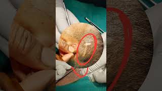 No cut, no scar – just clear skin! Watch this white spot vanish.