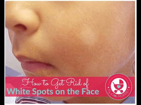 White Spots: What They Are and How To Get Rid Of Them - Center for