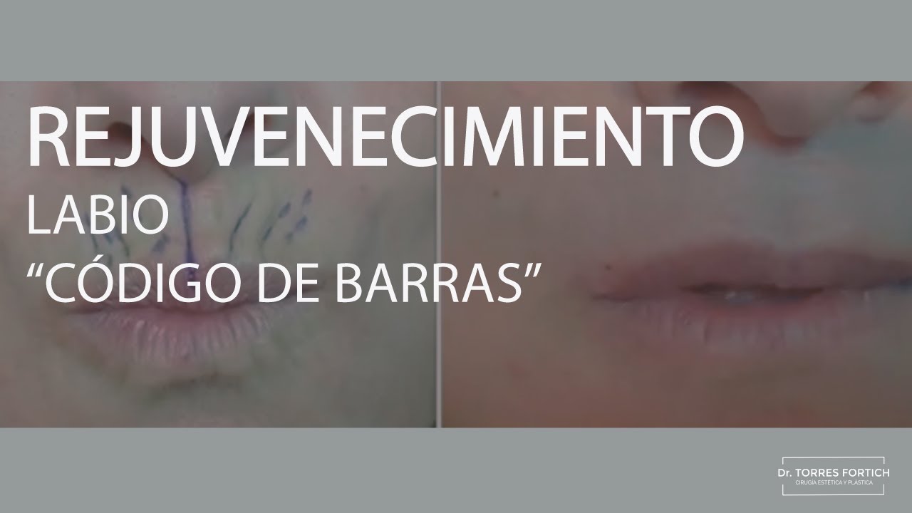 Relleno de arrugas peribucales