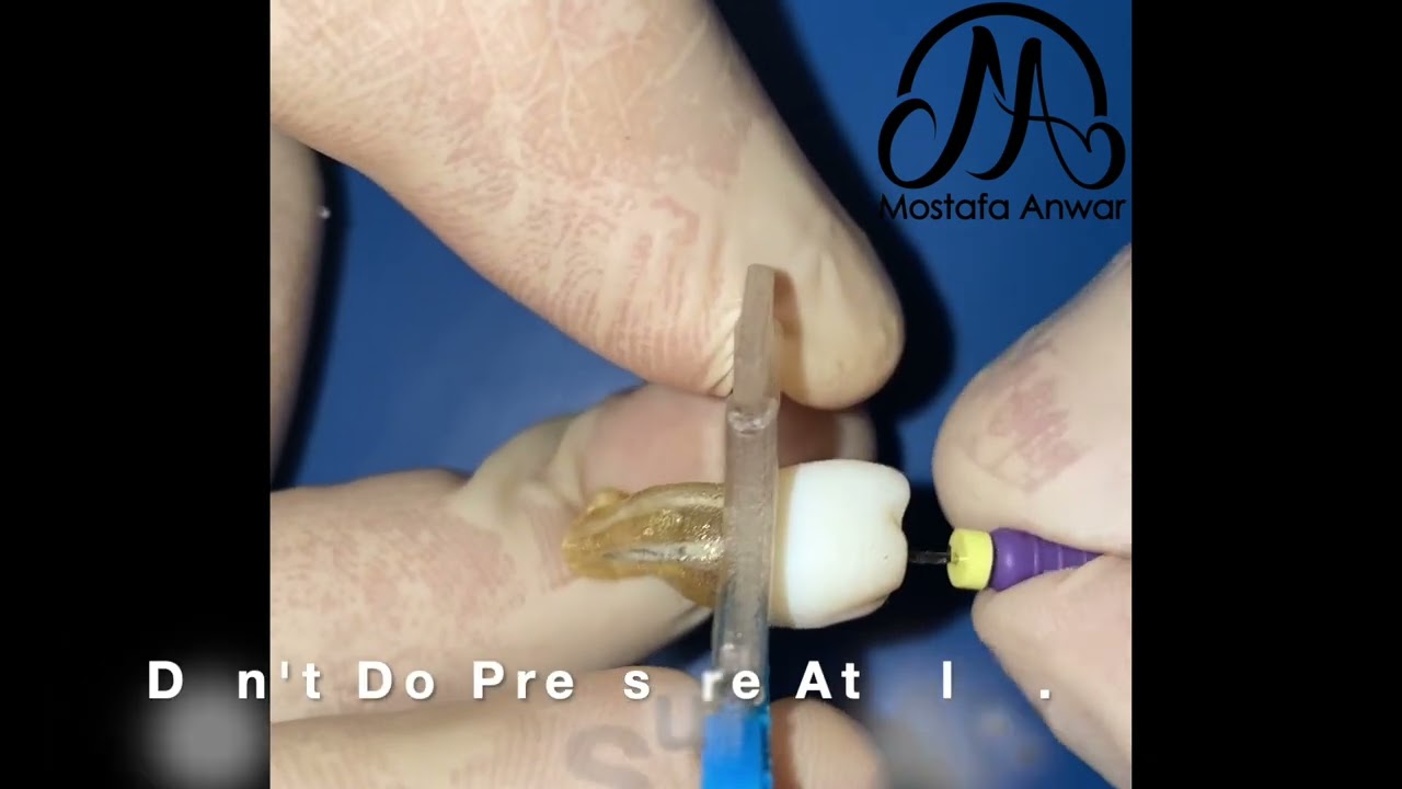 Bypass of Long Separated Rotary File in Middle Third of Root Canal | Molar | Broken File Bypass| RCT